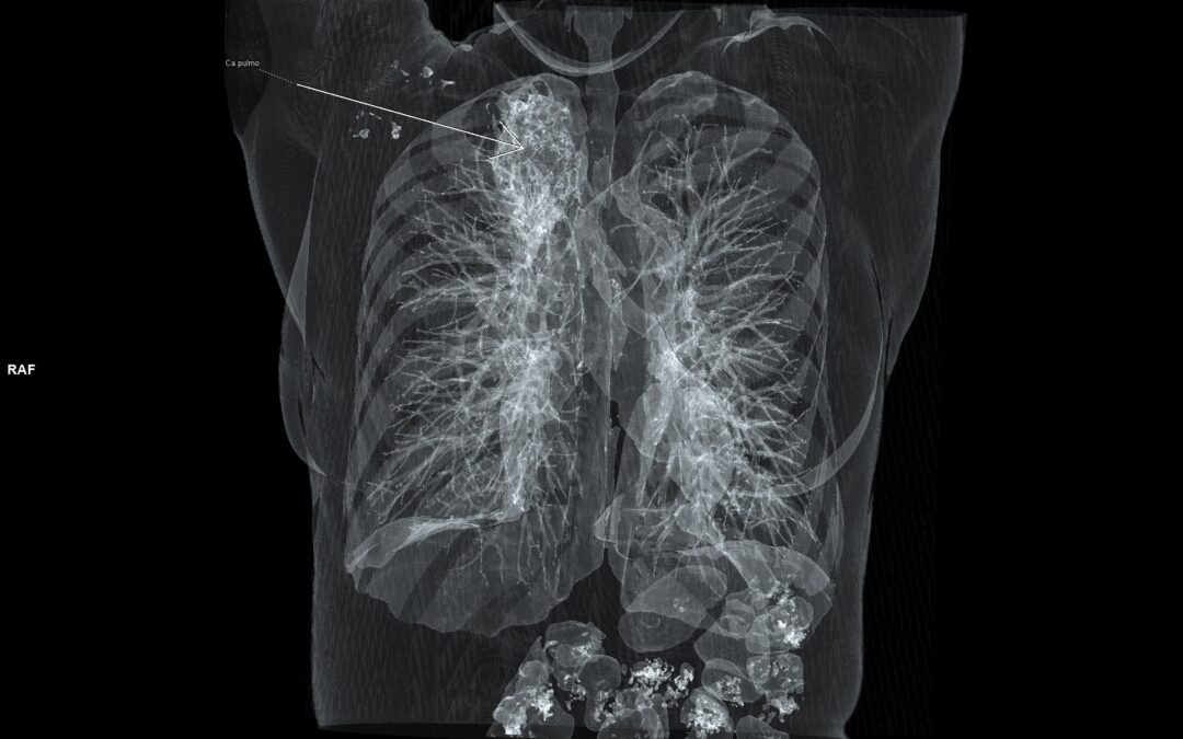Skrining karcinoma pluća